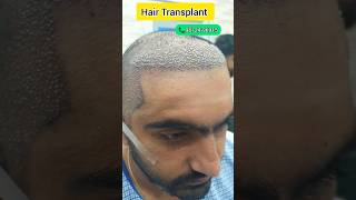 Best Hair Transplant Result in India  How to stop Hairfall hairclinic hairtransplant youtube [upl. by Amadas136]