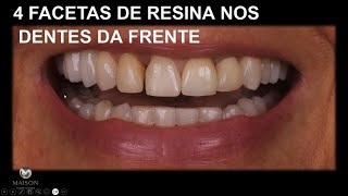 4 Dentes da Frente com Facetas de Resina [upl. by Rebecka]