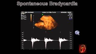 Fetal Echocardiograph Common Fetal Arrhythmias [upl. by Gemmell]