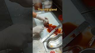 Cystic thyroid gland gross pathology [upl. by Atilrac]