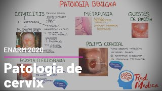 Cancer cervicouterino CaCU cervicitis y otra patología de cervix ENARM [upl. by Yorztif]