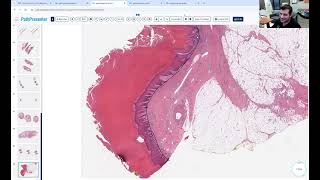 Avi Bitterman Dermpath Lecture 2 [upl. by Nagol270]