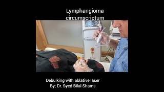 Lymphangioma circumscriptum  laser treatment  Dr Bilal Shams  Dermatologist [upl. by Ameerak468]