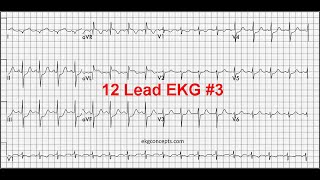 EKG Concepts easy 12 Lead Interpretation 3 [upl. by Refinaj]