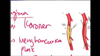 Patofisiologi Angina Pectoris  Pathway Angina Pectoris [upl. by Atikan]