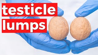 TESTICULAR CANCER  Why you should check your testicles for lumps [upl. by Alliuqahs]