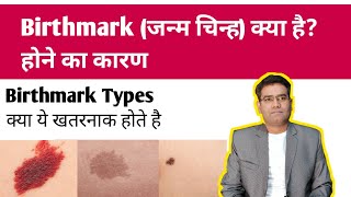 Birthmark Causes and Types  Is it Dangerous How to Remove birthmark [upl. by Valerian]