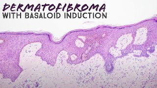 Dermatofibroma with basaloid follicular induction pathology mimic of basal cell carcinoma dermpath [upl. by Limber]