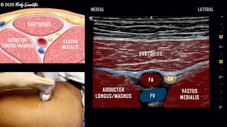 Adductor Canal Block Saphenous Nerve  UltrasoundGuided Demonstration [upl. by Avle]