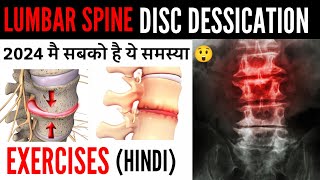 Disc desiccation with diffuse disc bulge  L4L5 L5S1 Low back pain पैरो मै दर्द  सुन्नपन जलन [upl. by Yerahcaz]