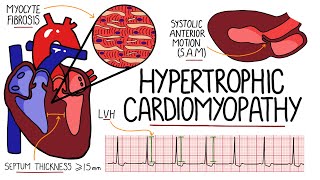 Hypertrophic Cardiomyopathy Made Easy  Includes Hypertrophic Obstructive Cardiomyopathy amp SAM [upl. by Aspasia]