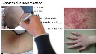 Dermatitis vs Eczema are they same Types of dermatitis symptoms prognosis and treatment [upl. by Kcirddes]