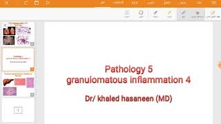 Bilharzial granulomatous reaction of the liverexample of non caseating granuloma [upl. by Wieren]