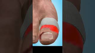 Ingrown Toenail Removal Animation  How To Do It Right [upl. by Ynnob]