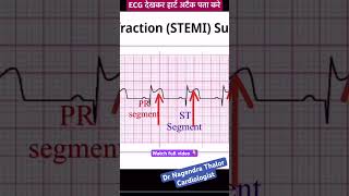 ECG से खुद हार्ट अटैक पता करे I How to read Heart attack ECG I ecg echo shorts [upl. by Jadwiga581]