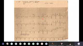 Cardiología  Electrocardiograma Deflexión intrinsecoide 14 de septiembre de 2020 [upl. by Ahsar]