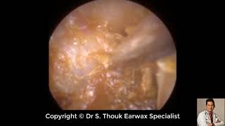 Top Biggest Ear Wax Removal 87  Ear wax Extraction  Dr S Thouk Earwax Specialist [upl. by Eward147]