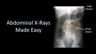 Abdominal XRays Made Easy [upl. by Aniroc]