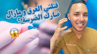 قتلتي العرق و مازال ضارك الضرسة ؟واش عادي أو لا؟ [upl. by Akerahs]