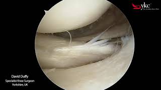 Watch a Knee Surgeon Treat a Meniscal Tear [upl. by Llehcor753]