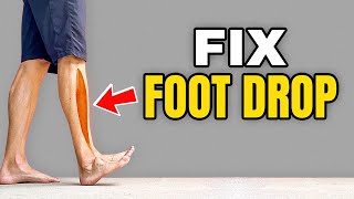 3 Exercises to Correct Foot Drop [upl. by Kcirederf]