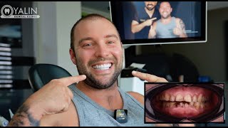 Full Mouth Zirconium Crowns Cost in Turkey Antalya  YALIN Dental Clinic Turkey  Testimonials [upl. by Bradman]