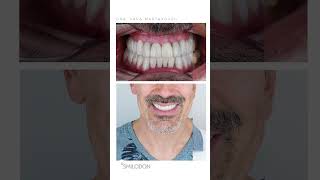 Caso clínico esteticadental · Coronas implantes y carillas shorts [upl. by Humfrid]