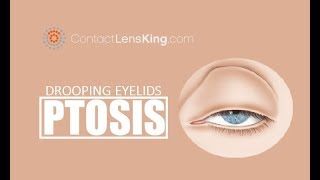 Drooping Eyelids  What causes Ptosis and How is it Treated [upl. by Azeria223]