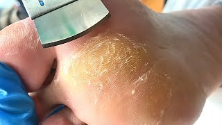 Callus removal from feetampFoot scraping dead skinasmr treatment【Xiao Yan pedicure】 [upl. by Hasila612]