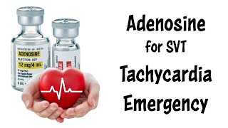 Treating Supraventricular Tachycardia SVT with Adenosine [upl. by Selegna134]