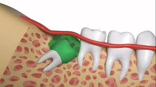 How To Safely and Quickly Have a Wisdom Tooth Extraction [upl. by Rebmeced747]