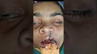 Secondary Lip Revision amp Alveolar Bone Grafting Surgery in Adult Cleft Patient [upl. by Janet843]