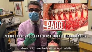 Adult Orthodontics PAOO [upl. by Naruq717]