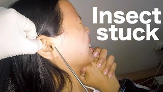 Removing INSECT Stuck in Womans Ear [upl. by Kirsch]