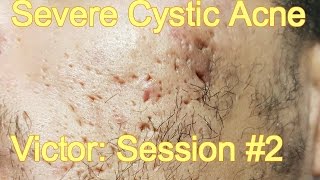 Severe Cystic Acne  Victor Session 2 [upl. by Nahtanohj]