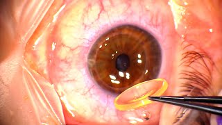 Corneal Transplant Penetrating Keratoplasty for Advanced Keratoconus and Corneal Infiltrates [upl. by Limber]