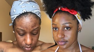 HOW TO CLEAR ACNE IN LESS THAN A MONTH [upl. by Lettig640]