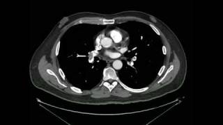 Tromboembolismo Pulmonar Angio tomografia [upl. by Anirbas]