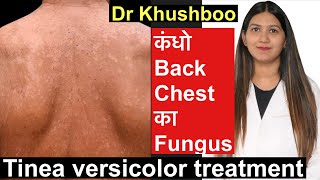 Tinea Versicolor Treatment  सेहुआ करोडियासीप Tinea body fungus treatment [upl. by Nosnevets]