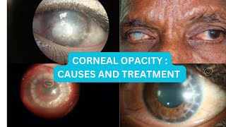 Why does the cornea turns white Corneal opacity causes and treatment [upl. by Adnoma]