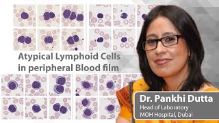 Commonly seen and not so commonly seen Atypical Lymphoid in the peripheral blood  Dr Pankhi Dutta [upl. by Septima]