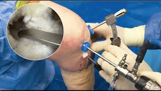 Combined ACL and Meniscal Root Tunnel Drilling [upl. by Mcclelland]