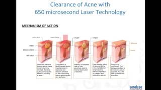 Advanced Laser Technology for Acne in Skin of Color with David J Goldberg MD JD Dermatologist [upl. by Aylad]