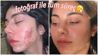 Fotoğraflı Roaccutane Sürecim🥵🧖🏻‍♀️ Sivilce Tedavisi✨ [upl. by Rafter]