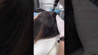 Calecim Advanced Hair System MicroNeedling at Dr MediSpa [upl. by Amaerd]