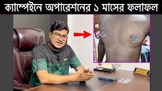 গাইনেকোমাস্টিয়া সার্জারির ১ মাসের চমৎকার ফলাফল  Gynecomastia Surgery Result in Bangladesh [upl. by Yob]