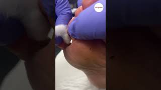 Pinch Callus Tyloma Removal [upl. by Deck]