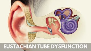 What is Eustachian Tube Dysfunction [upl. by Nycila889]