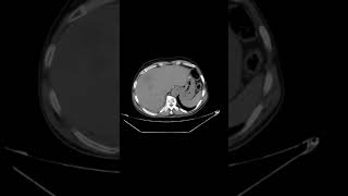 Multiple liver abscess [upl. by Lamonica]