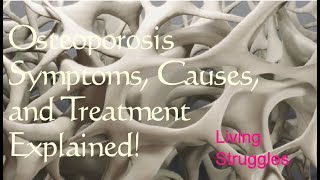 Osteoporosis Symptoms Causes and Treatment Explained [upl. by Norri]